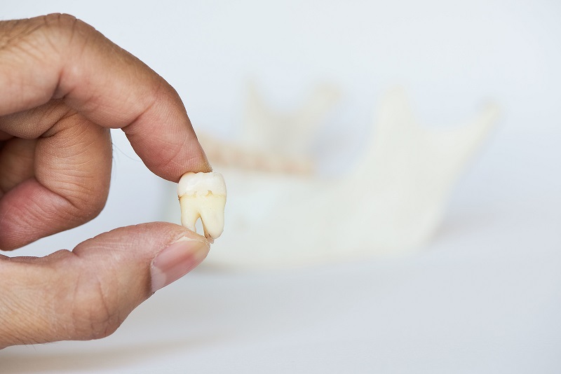 3 Benefits of Getting Your Wisdom Teeth Removed
