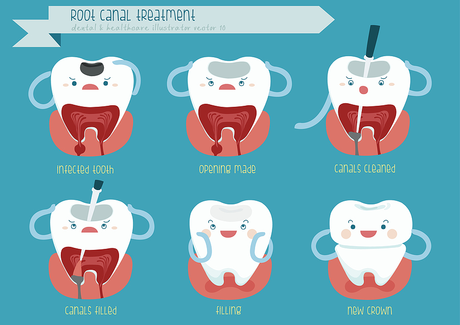 Root Canal Treatment: Saving Your Tooth, Restoring Your Smile